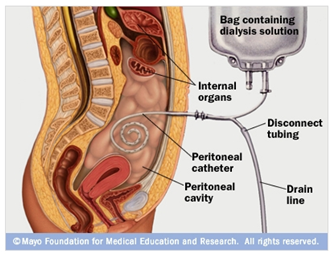 Peritoneal